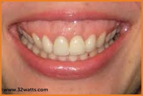 rejove32aligners - Lips and Orthodontics