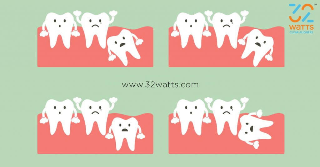 What is Lingual Braces Advantages