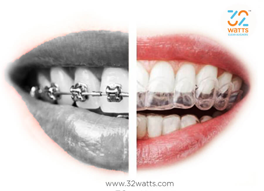 Braces vs Clear Aligners